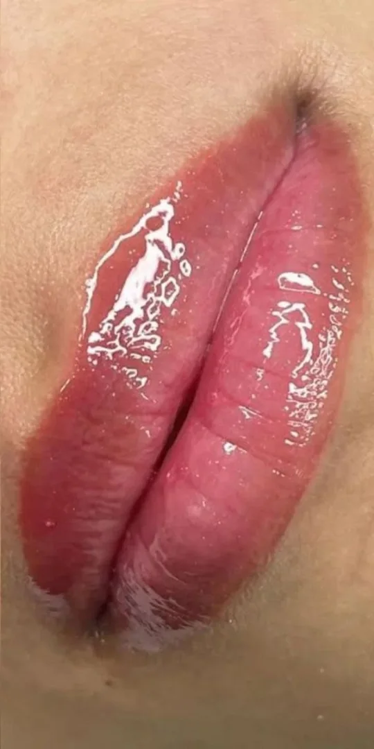 Lábios após o microagulhamento labial, mais hidratados e uniformes