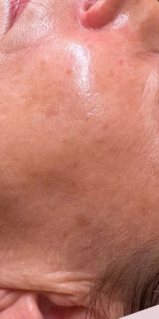 Mesma região após o peeling químico, com tom mais uniforme